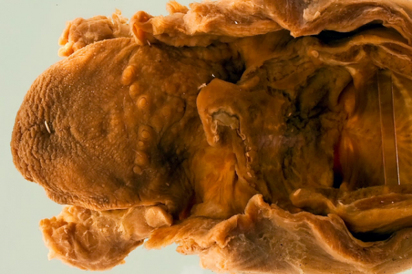 Erythema nodosum leprosum in the larynx