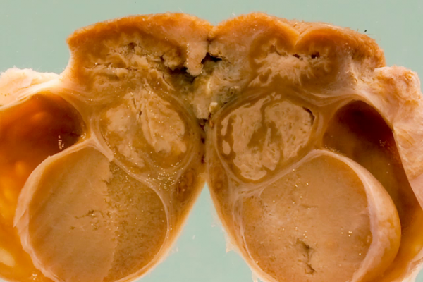 Tuberculous epididymitis