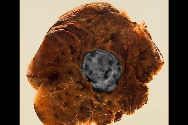 Tuberculoma of the lung