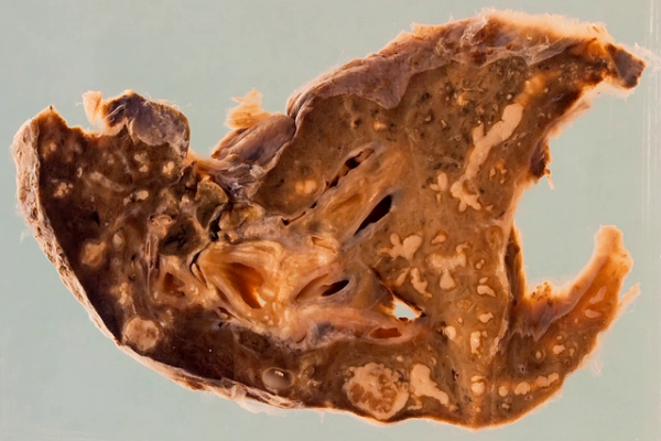Tuberculosis of the lung