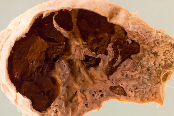Tuberculosis with fatal haemorrhage