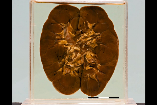 Kidney in Blackwater fever (Falciparum malaria)