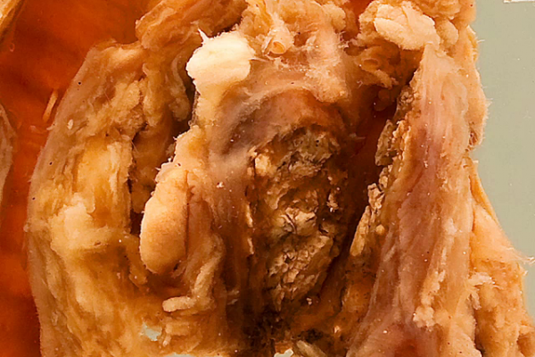 Carinal lymph node (tuberculosis)