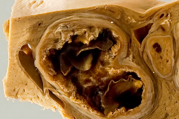 Sheep liver with fascioliasis