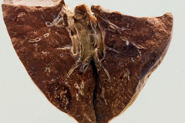 Influenzal bronchopneumonia