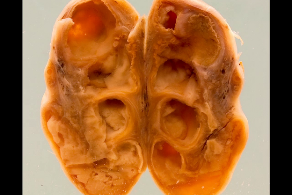 Gonococcal salpingo-oophoritis
