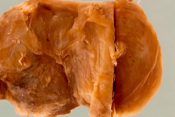 Onchocercal nodule
