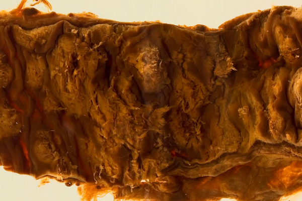 Amoebiasis (Colon)