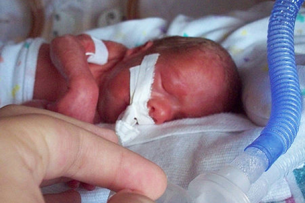 Premature baby on a ventilator