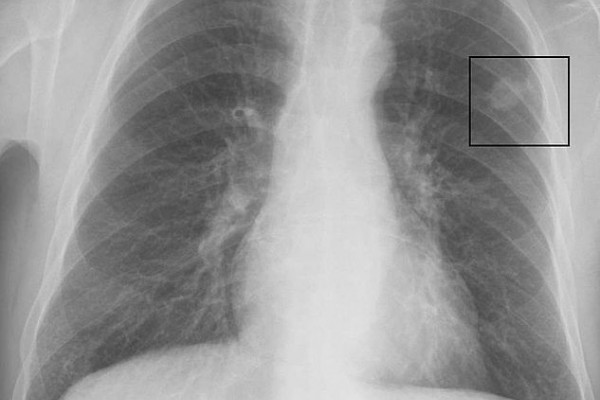 Chest x-ray showing lung cancer in the left lung.