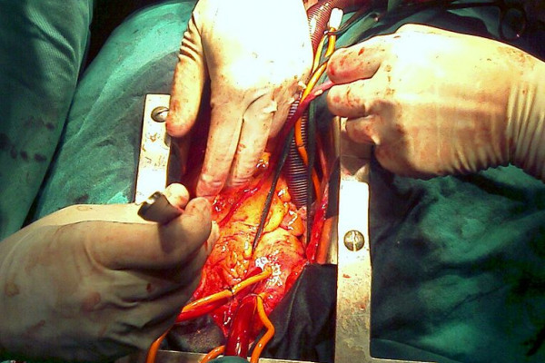 Human heart seen in a cardiac surgery operating room