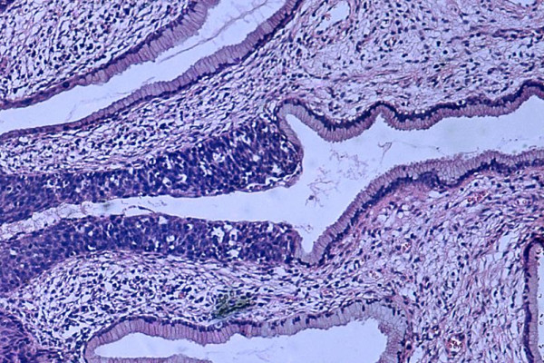 High grade dysplasia (carcinoma in situ) in the uterine cervix. The abnormal epithelium is extending into a mucus gland to the left of centre. This disease can progress to invasive cancer (squamous cell carcinoma) of the cervix.