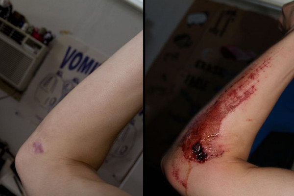 A comparative picture of untreated 7-days-healed road rash in the form of a scar one year later. Fresh wound is on the right, and scar is on the left.