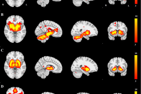 The distribution of brain atrophy in patients with Parkinson's Disease has a network structure.
