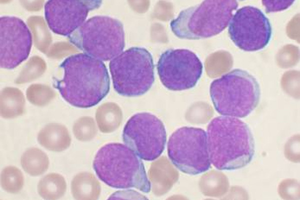 A Wright's stained bone marrow aspirate smear of patient with precursor B-cell acute lymphoblastic leukemia.