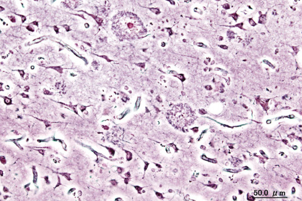 Histopathogic image of senile plaques seen in the cerebral cortex in a patient with Alzheimer disease of pre-senile onset. Silver impregnation.