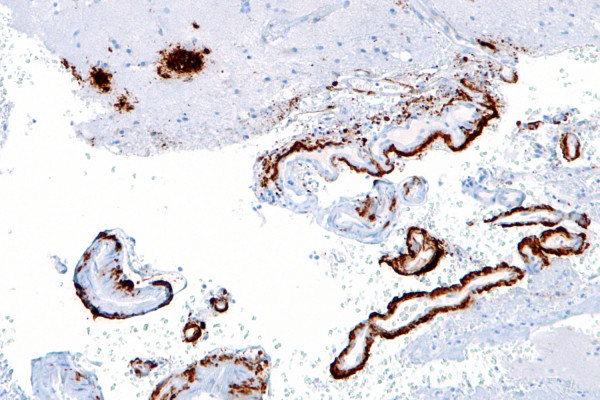Intermediate magnification micrograph of cerebral amyloid angiopathy with senile plaques in the cerebral cortex consistent of amyloid beta, as may be seen in Alzheimer disease. Amyloid beta immunostain.