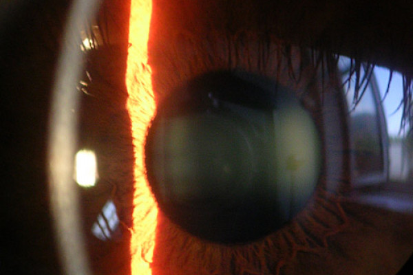 Slit lamp image of cornea, iris and lens.