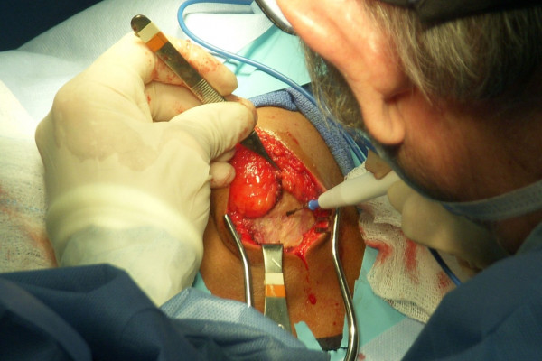 A surgeon using electrosurgical cautery in the excision of a lipoma