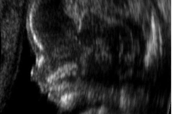 Embryo at 14 weeks