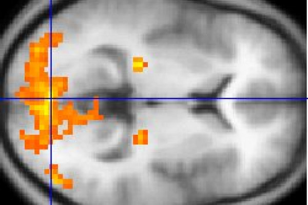  This example of fMRI data shows regions of activation including primary visual cortex (V1, BA17), extrastriate visual cortex and lateral geniculate body in a comparison between a task involving a complex moving visual stimulus and rest condition...