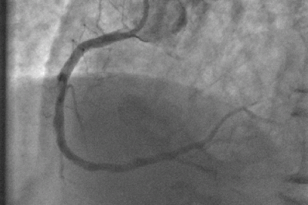 Figure 3: The right heart artery has been opened and the stent has been positioned below the catheter tube.