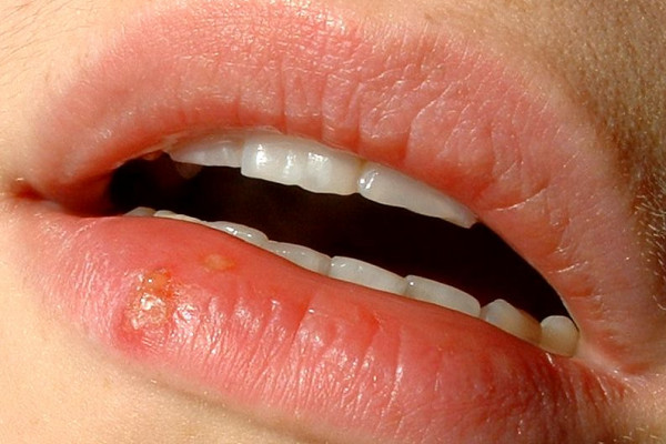 Cold sore on the lower lip (cluster of fluid-filled blisters = very infectious). These infections may appear on the lips, nose or in surrounding areas.