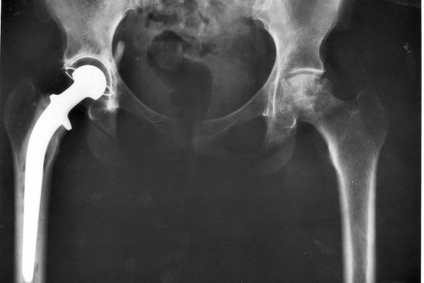 Total hip replacement, x-ray