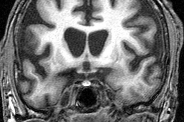 Coronal image of the human brain at the level of the caudate nuclei demonstrating marked reduced volume in keeping with the patient's known diagnosis of Huntington disease.