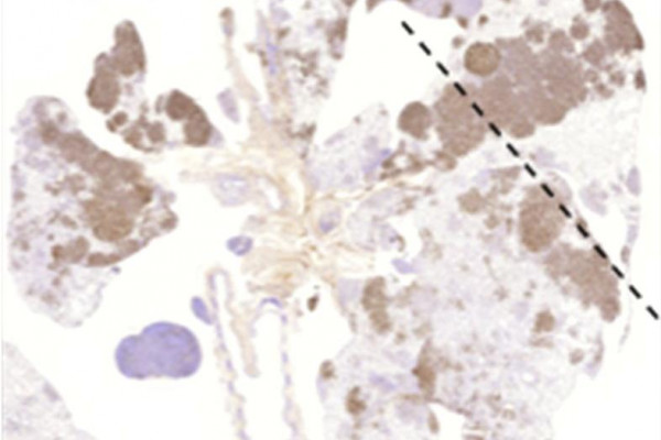  Lung cancer in mice with expression of two different cancer causing mutations. When we actually took the tumours out of these mice later on, and actually looked to see if both these genes were expressed, we found that only one of the two was...