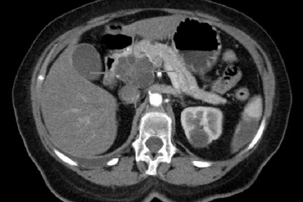 Axial CT image with i.v. contrast. Macrocystic adenocarcinoma of the pancreatic head.