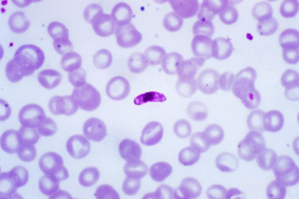 A photomicrograph of a blood smear containing a macrogametocyte of the parasite Plasmodium falciparum.