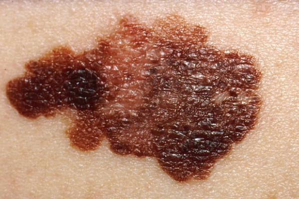 Photograph showing the appearance of melanoma, a pigmented skin cancer.
