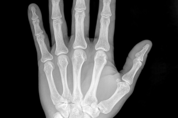 X ray of hand