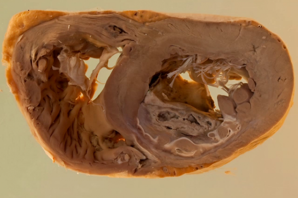 Old infarct with mural thrombus