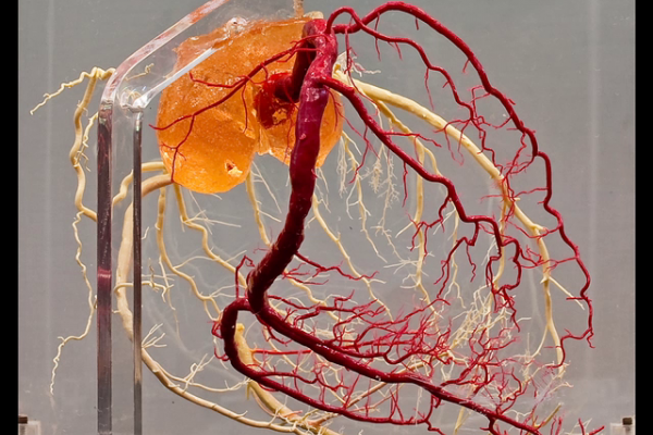 Normal coronary arteries