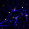 Dementia neuron