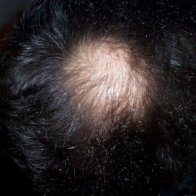 A bald patch A bald patch