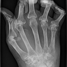 Rheumatoid Arthritis x-ray