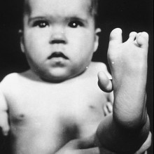 Thalidomide Deformed baby