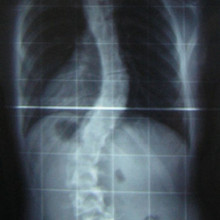 An X-ray of the spine of a patient with scoliosis