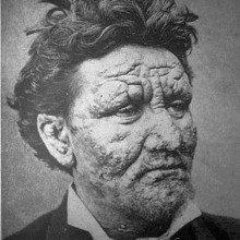 A 24-year-old leper, photographed in Sweden in 1886 A 24-year-old leper, photographed in Sweden in 1886