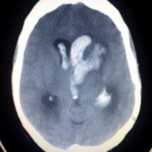 This image shows an Intracerebral and Intraventriclar haemorrhage of a young woman. The woman was one week post partum, with no known trauma involved.
