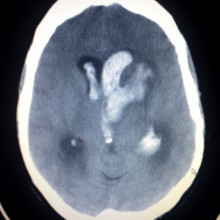 Intracerebral and Intraventriclar haemorrhage This image shows an Intracerebral and Intraventriclar haemorrhage of a young woman. The woman was one week post partum, with no known trauma involved.