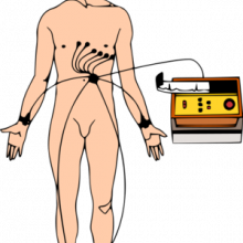 Diagram showing the connection of ECG leads