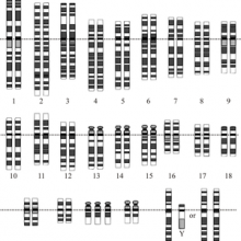 Down's Syndrome Karyotype