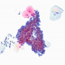 Cytological specimen (ThinPrep) from a patient who was later diagnosed with cervical adenocarcinoma in situ. There is at least one mitosis.