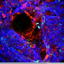 Damaged blood-brain barrier