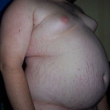 Picture of an Obese Teenager (146kg/322lb) with Central Obesity, side view