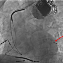 Pacemaker Pacemaker